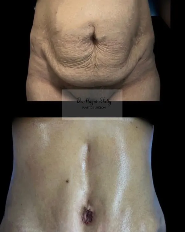 This is the result of an abdominoplasty, or tummy tuck, for a mother of two who wanted to restore her pre-pregnancy abdomen. We not only removed excess skin and fat but also surgically repaired the separated abdominal muscles, creating a flatter, firmer, and more toned midsection.