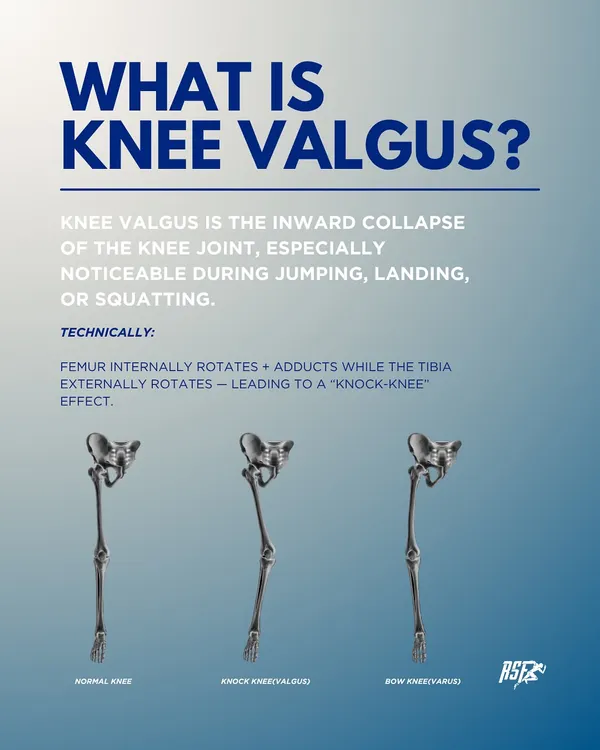 This infographic explains Knee Valgus, the inward collapse of the knee, which is a major risk factor for ACL injuries. I assess every athlete for this and other movement faults to correct the pattern before it causes a problem.