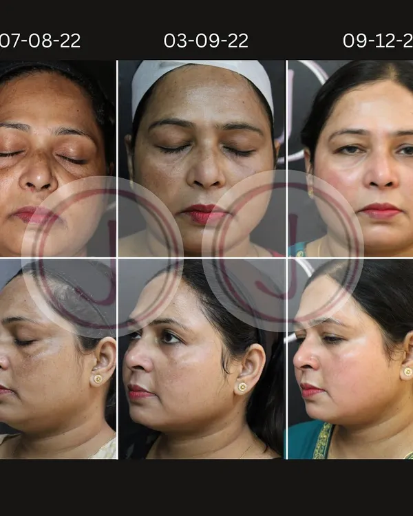 This series shows a patient's progress over five months in treating significant hyperpigmentation. With consistent, steroid-free depigmenting peels and laser sessions, we achieved a remarkable improvement in skin clarity and tone.