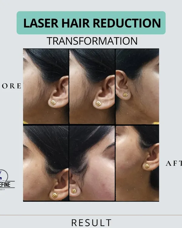 A clear view of a sideburn and cheek laser hair reduction journey. The 'after' photos show not just the absence of hair, but also smoother skin texture, free from the irritation that frequent hair removal can cause.