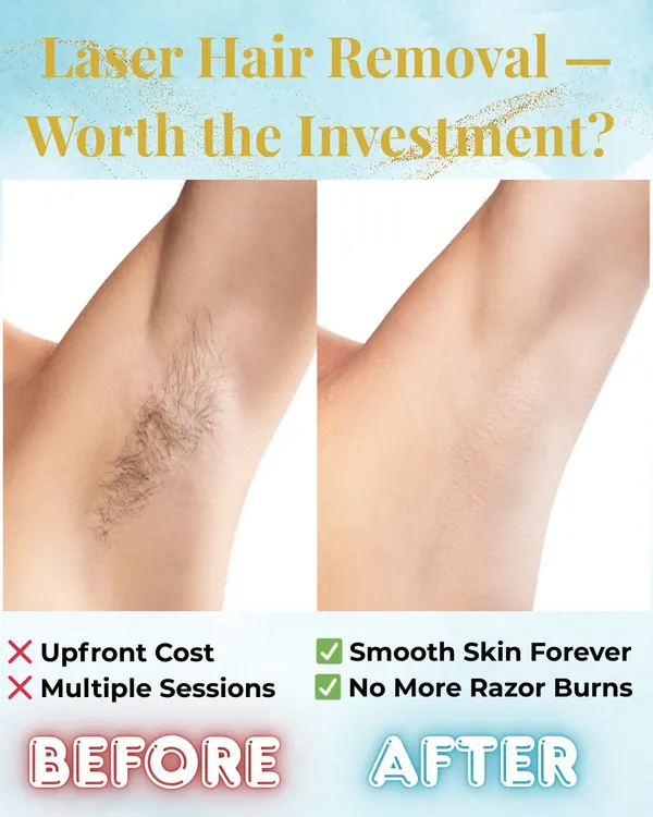 Is laser hair removal worth the investment? This before-and-after of an underarm treatment clearly shows the result: permanently smooth skin with no more razor burns or stubble.