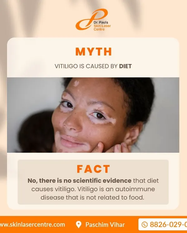 A common myth is that certain foods cause vitiligo. The fact is, vitiligo is an autoimmune condition and is not related to your diet. Understanding the science behind the condition is the first step toward effective management.