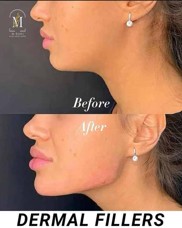 I specialize in creating a naturally sculpted and defined jawline using US FDA-approved dermal fillers. This before and after shows how we can enhance facial harmony and create a sharper profile in a single session.
