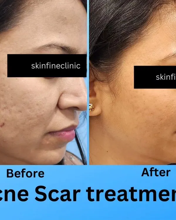 This before and after image shows the significant reduction of acne scars after a few sessions of Microneedling Radiofrequency (MNRF). This procedure helps rebuild collagen and smooths out skin texture, effectively treating deep-pitted scars for a clearer complexion.