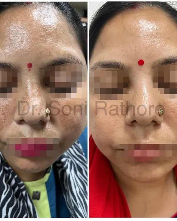 This before-and-after shows a significant reduction in melasma. The result was achieved through a dedicated plan combining prescription creams, a series of chemical peels, and targeted laser treatments.