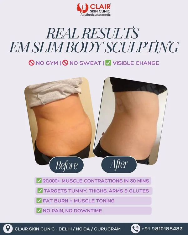(Hero Media) See the real, visible change for yourself. This client achieved significant fat reduction and a more toned waistline with our EM Slim body sculpting treatment. This is the power of stimulating over 20,000 muscle contractions in just 30 minutes, with absolutely no downtime.