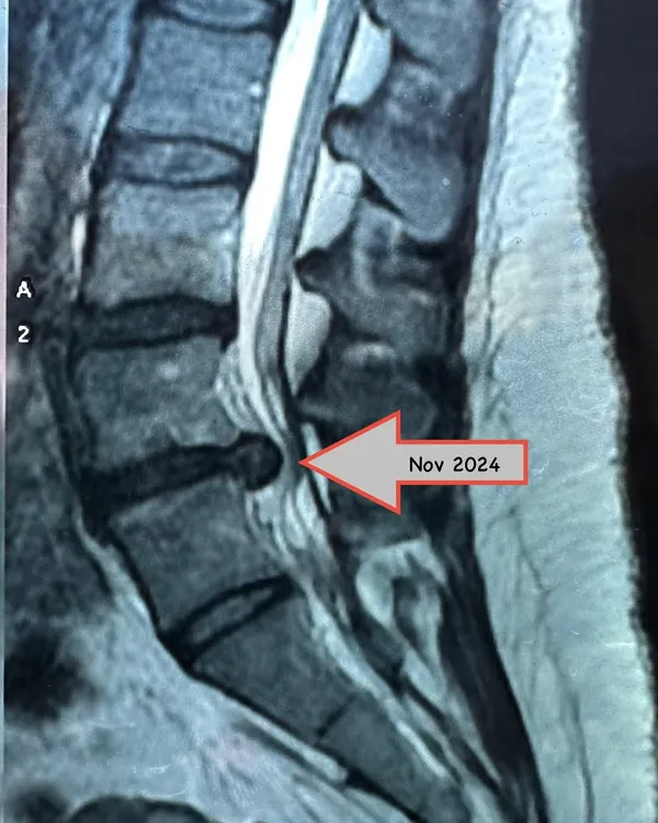 This MRI shows a severe disc bulge from a patient who was told surgery was her only option. This is the kind of challenge I love to take on, proving that dedicated physiotherapy can create incredible outcomes.