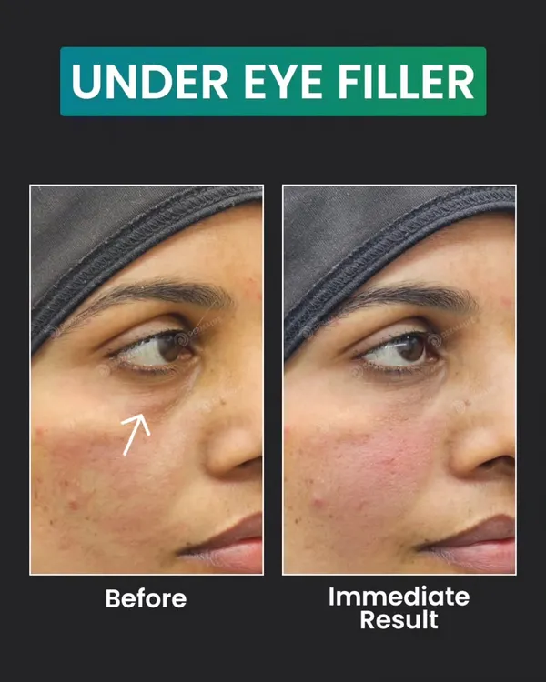 This before-and-after image shows the immediate effect of under-eye fillers in correcting the tear trough area. The treatment smooths the transition between the lower eyelid and cheek, reducing the shadow that makes eyes look tired.