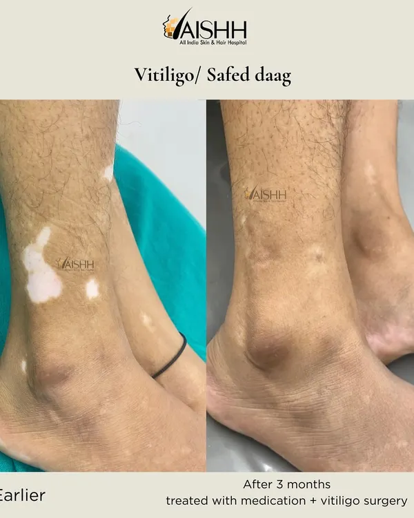 This is the result I strive for. This patient's vitiligo, or safed daag, on the ankle was treated over three months using a combination of medication and vitiligo surgery. Restoring skin colour is not just a medical procedure; it's about helping someone regain their confidence.