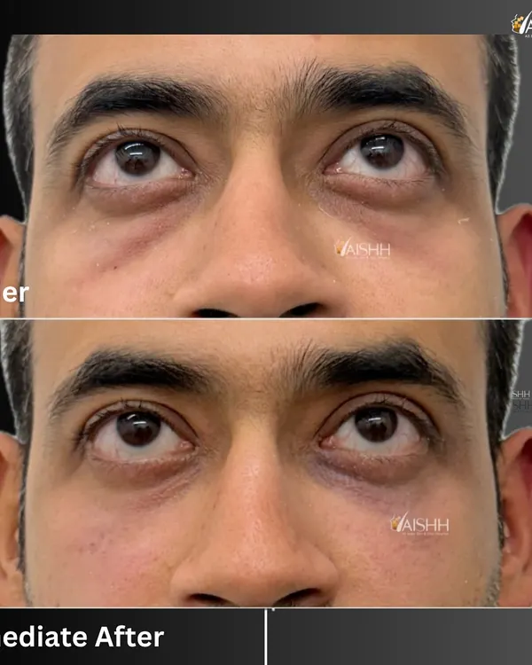 An immediate before and after of an under-eye filler treatment. Just 1 ml of hyaluronic acid was used to fill the hollows, significantly reducing the tired and dull look.