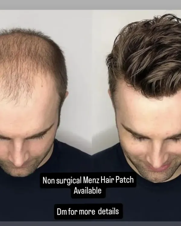 A clear before and after view of our non-surgical men's hair patch. This system is designed to cover male pattern baldness, integrating seamlessly with existing hair for a completely natural and undetectable finish.