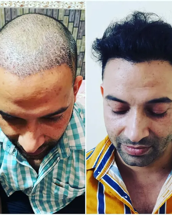 A powerful transformation achieved through our FUE hair transplant procedure. We focus on creating a dense, natural-looking hairline that restores not just hair, but also confidence.