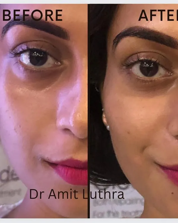 This is the transformative power of under-eye fillers. By carefully treating the tear trough area, we can reduce hollowness and dark circles, helping you look rested and significantly more refreshed.