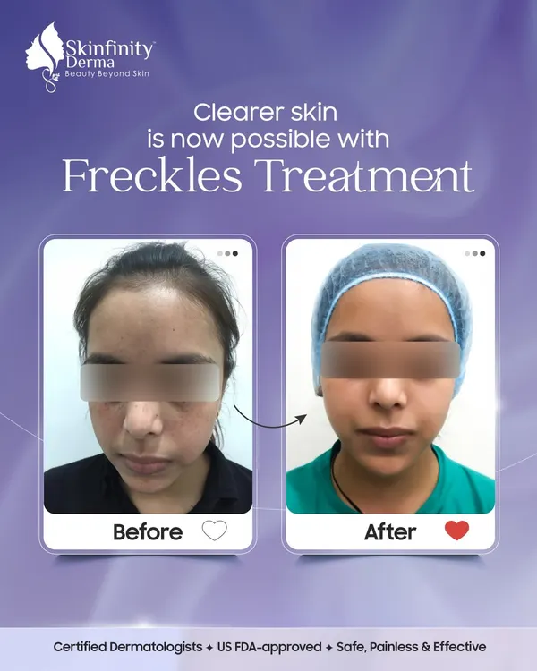 This before-and-after shows the significant reduction of freckles using our advanced treatments. We use safe and effective methods like laser therapy to target pigmentation, resulting in clearer, more even-toned skin and renewed confidence for our patient.
