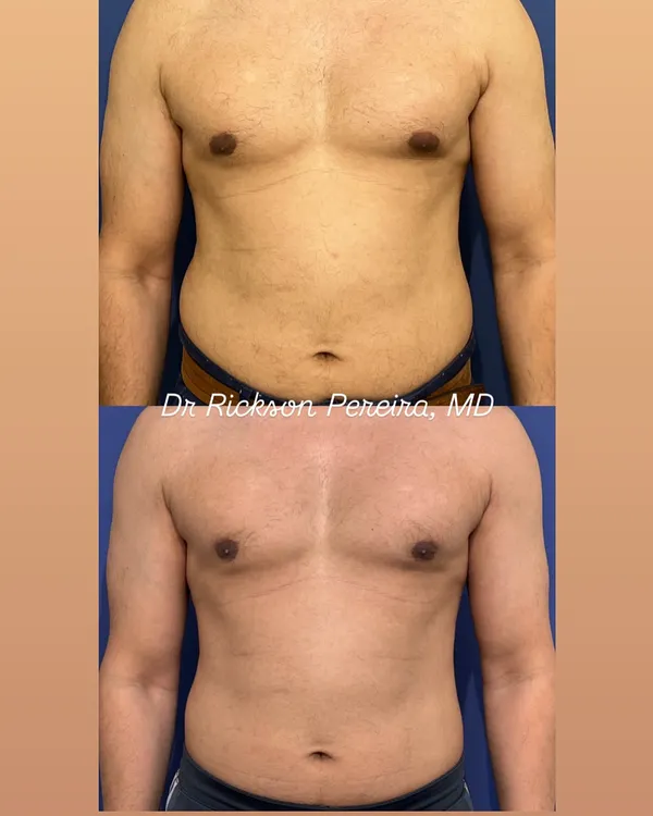This is the result of my evidence-based fat loss program after just 8 weeks. We focus on true body recomposition, reducing fat primarily in the mid-section while carefully preserving vital muscle mass. This approach ensures you not only look better but also improve your long-term metabolic health.