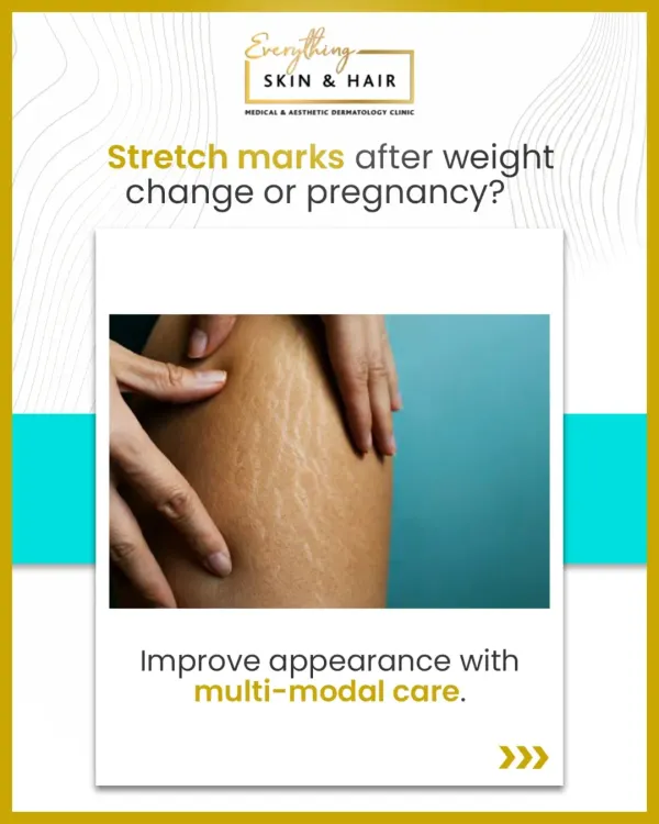 This graphic introduces the common issue of stretch marks, or striae, which can appear after periods of rapid skin stretching. It emphasizes my multi-modal care approach, which is crucial for achieving visible improvement.