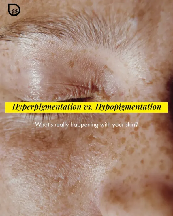 Understanding the difference between hyperpigmentation (dark spots) and hypopigmentation (light spots) is the first step. This image highlights the visual characteristics of these common concerns.
