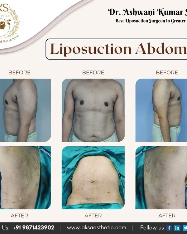 This is a powerful example of what abdominal liposuction can achieve. I focused on removing stubborn fat from the abdomen and flanks to create a significantly flatter and more defined midsection. The result is a natural-looking contour that diet and exercise alone could not accomplish.