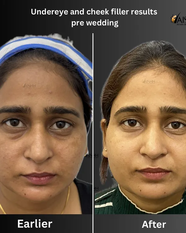 A tired appearance is often caused by volume loss under the eyes and in the cheeks. For this pre-wedding transformation, I used hyaluronic acid fillers to restore that youthful contour, complemented by chemical peels for an overall brighter complexion.