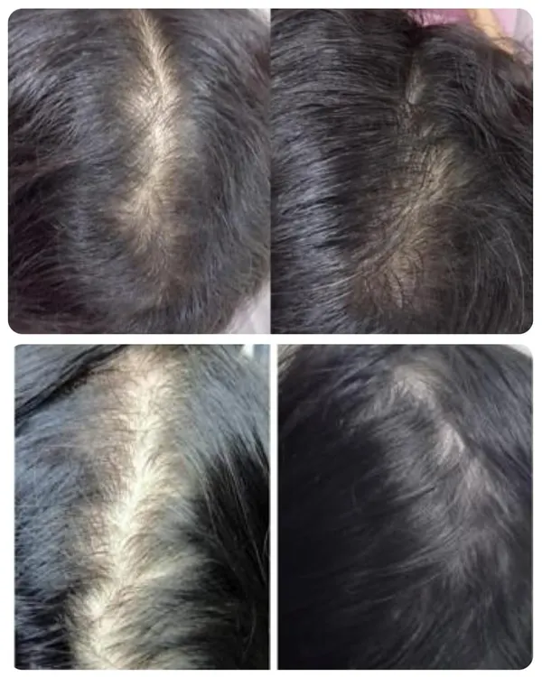 This before-and-after image shows the visible improvement in hair density and scalp coverage following a combination therapy for hair restoration. It demonstrates that with the right diagnosis and consistent treatment, significant regrowth is possible.