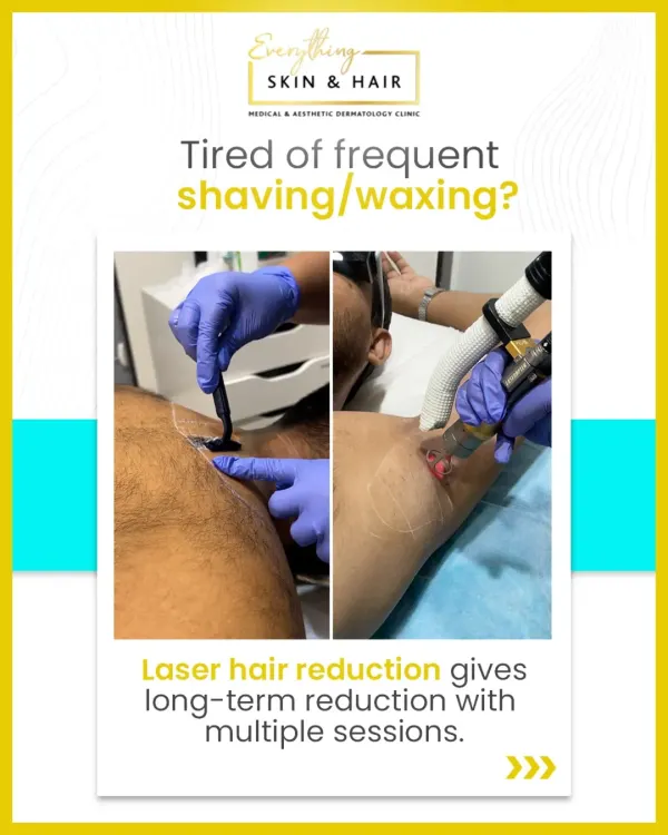 This visual directly addresses the hassle of traditional hair removal methods. Our laser treatments provide a long-term reduction, freeing you from the constant upkeep of shaving and waxing.