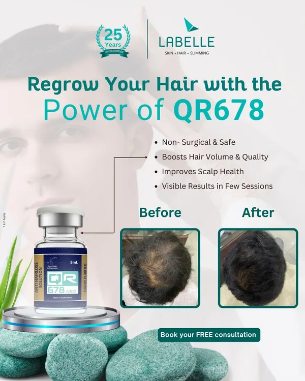 This is the power of our advanced QR678 treatment. This before and after image shows a significant increase in hair density and scalp coverage after just a few sessions. This non-surgical solution is one of our most effective for reversing hair thinning and boosting hair volume.