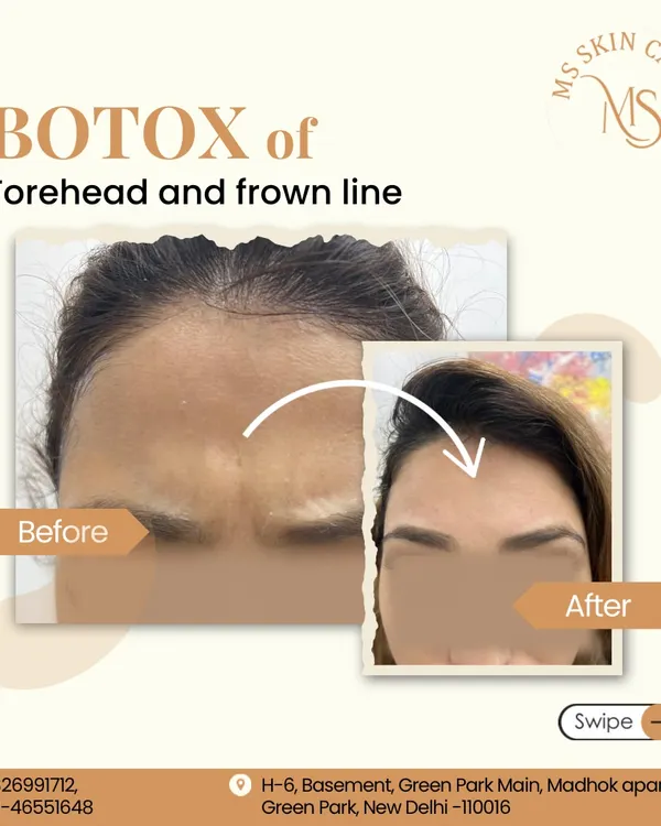 This before and after shows the significant yet natural-looking reduction of forehead and frown lines using Botox. The treatment relaxes the underlying muscles, resulting in smoother, more youthful skin.