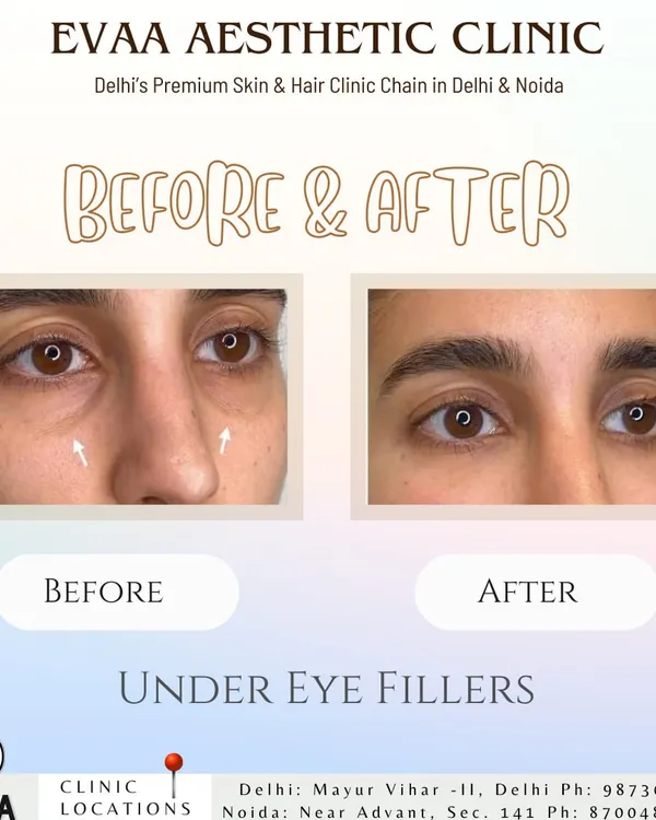 A clear before-and-after comparison showcasing the immediate effect of our under-eye filler treatment. We effectively reduced hollows and dark circles, resulting in a significantly more rested and rejuvenated appearance for our client.