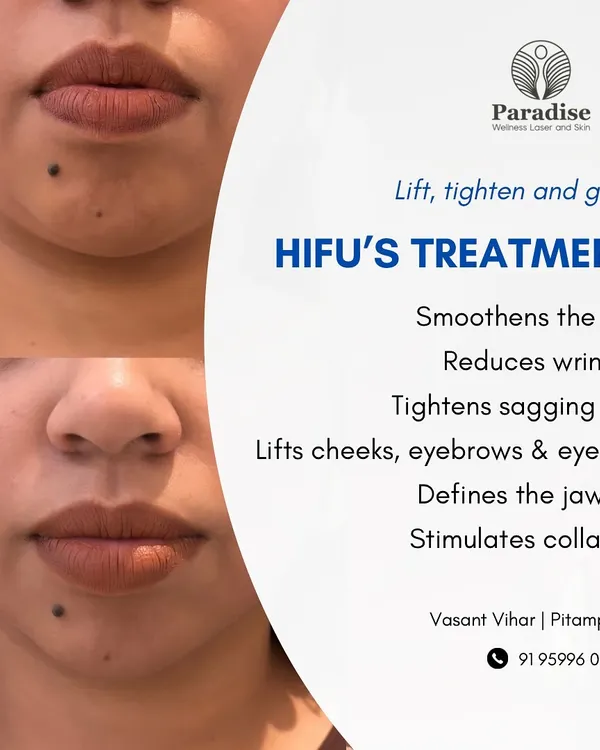 This before-and-after demonstrates how HIFU treatment visibly tightens sagging skin around the mouth and jawline. By stimulating collagen, it smooths the skin and restores a more youthful contour.