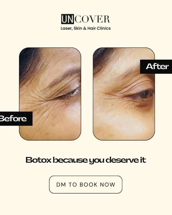 Here is a before and after of a Botox treatment for crow's feet. Notice how the lines around the eyes are softened, giving a more rested and youthful appearance while maintaining natural expression.