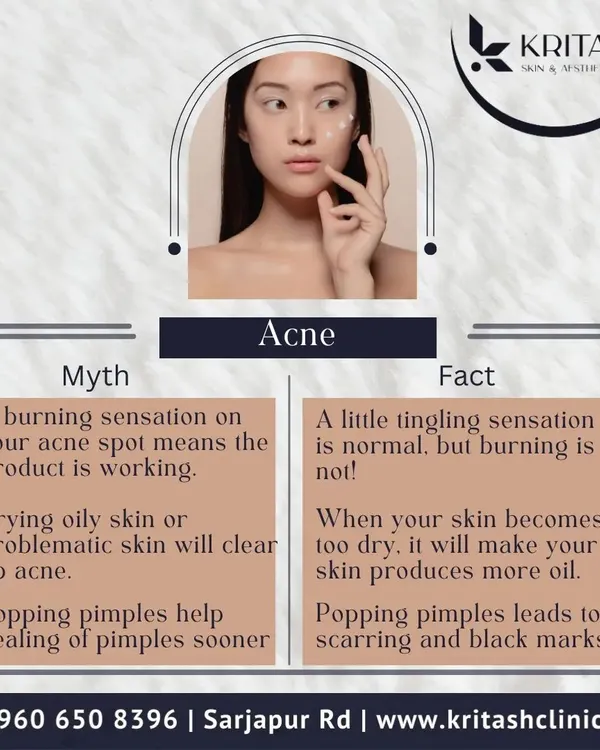 Let's clear up some common myths about acne. A burning sensation is a sign of irritation, not effectiveness, and popping pimples will almost always lead to scarring or post-inflammatory hyperpigmentation. Proper treatment focuses on balance, not aggression.