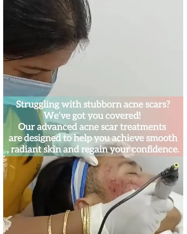 A client undergoes an advanced treatment for stubborn acne scars. We use targeted procedures like microneedling to stimulate the skin's natural healing process, helping to build collagen and visibly reduce the depth and texture of scars for smoother, more radiant skin.