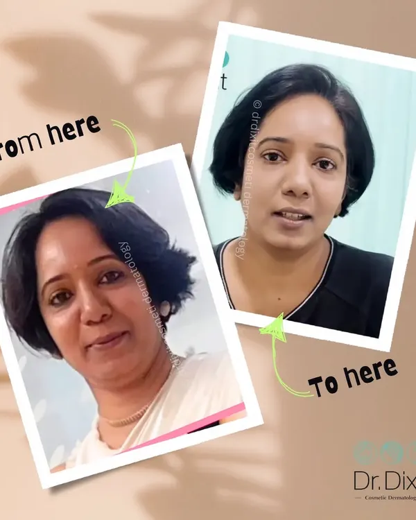 This is a powerful example of what a customized anti-aging plan can achieve. By addressing specific concerns with the right procedures, we were able to create a naturally refreshed and rejuvenated appearance for my patient.