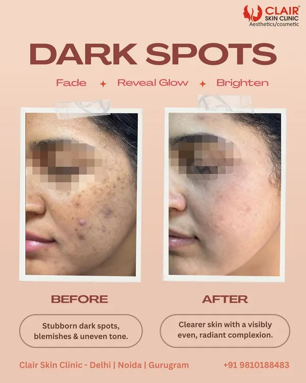 A clear transformation showing the fading of stubborn dark spots and blemishes. Our targeted treatments result in a visibly clearer, more even, and radiant complexion, restoring skin confidence.