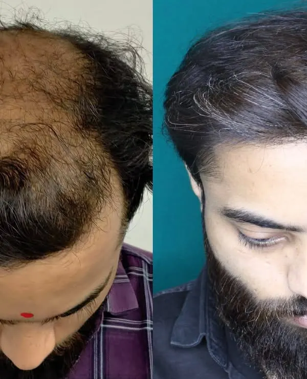 This is the kind of result that changes lives. This patient came to me with advanced thinning across the entire top of his scalp. Using a high-density graft placement, I was able to restore full coverage, creating a thick and completely natural-looking head of hair.