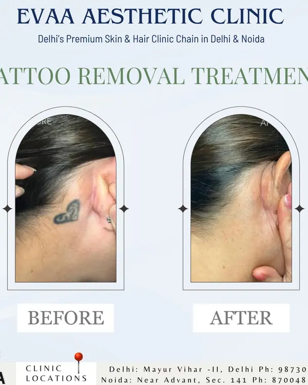 A clear demonstration of our advanced laser tattoo removal capabilities. This before and after shows the significant fading of a dark ink tattoo behind the ear, resulting in clear, smooth skin with minimal trace of the original artwork.