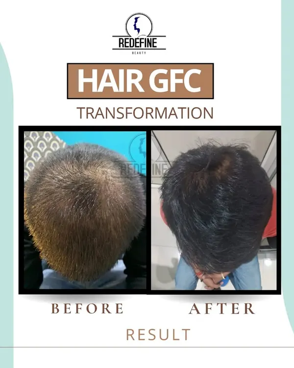 A clear before and after result of our Hair GFC Transformation. This image shows a significant increase in hair volume and coverage on the crown area, demonstrating the power of this non-surgical hair restoration treatment.