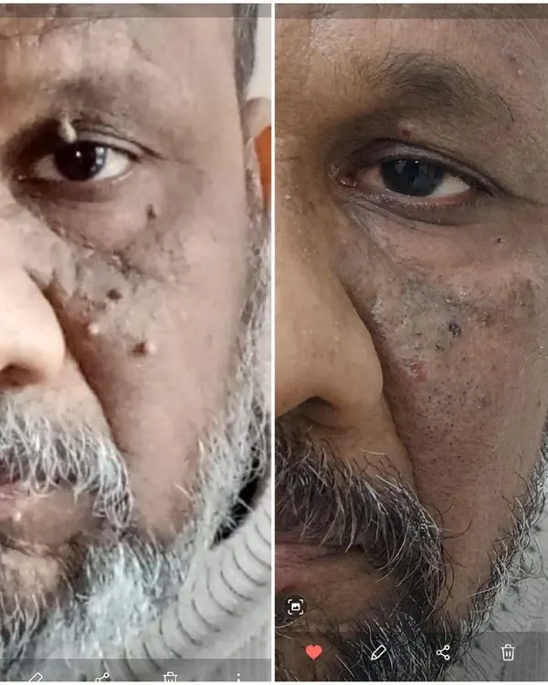 This before-and-after image shows the significant clearance of multiple facial skin tags for one of our patients. We were able to remove numerous growths from around the eye and cheek area in a single session, resulting in much smoother and clearer skin.