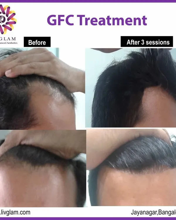 This client's hairline was restored after just three sessions of our non-surgical GFC treatment. Notice the significant increase in hair density and the natural-looking frontal coverage.
