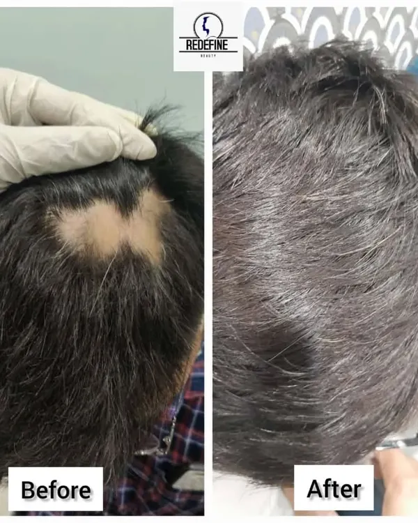 A fantastic before and after result for a client with alopecia areata. The initial image shows a significant bald patch, and the after image displays complete hair regrowth, showcasing the effectiveness of our targeted treatment plan.