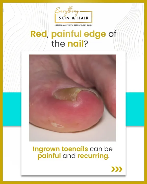 A red, painful, and swollen nail edge is a classic sign of an ingrown toenail. This condition can be recurring and lead to infection if not properly managed by a dermatologist.