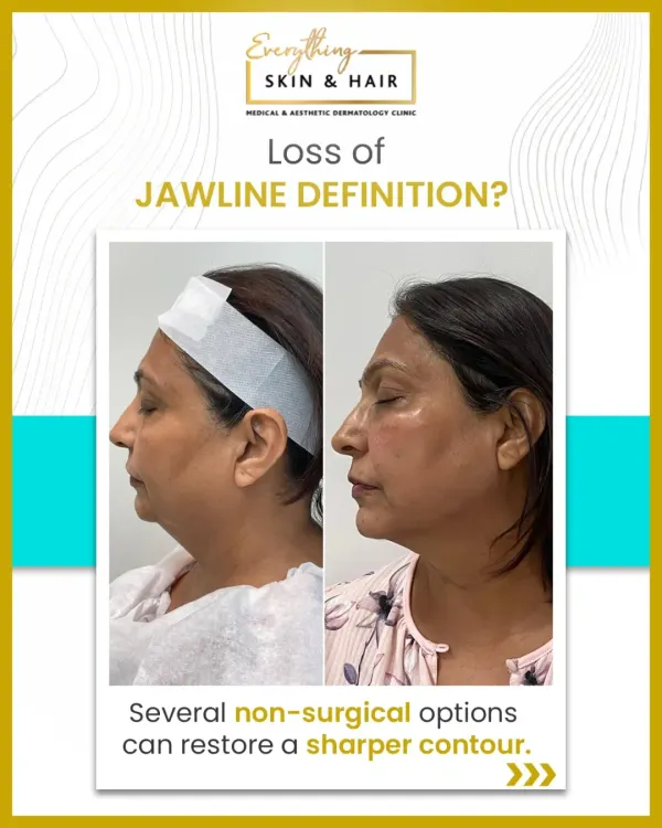 This transformation showcases the power of a well-defined jawline. By strategically combining non-surgical treatments, I was able to restore structure and lift to the lower face, resulting in a significantly sharper and more youthful profile for my patient.