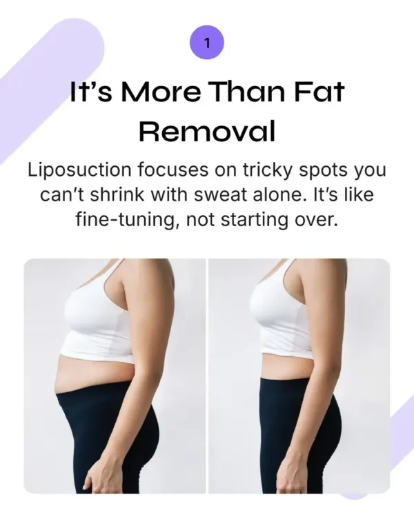 (Hero Item) This is where the art of body contouring begins. It is not just about removing fat, but about carefully sculpting a new silhouette that aligns with your goals. My approach is to fine tune your shape for a natural, refined result that diet and exercise alone cannot achieve.