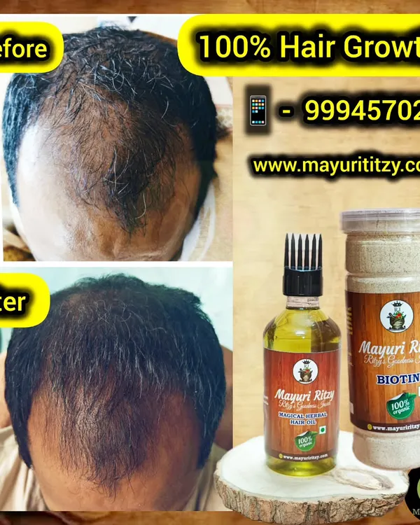 This is why I do what I do. This before and after image shows the real possibility of hair regrowth with consistent use of my Biotin Powder and Magical Herbal Hair Oil. It’s not a quick fix, but a natural journey to healthier hair.