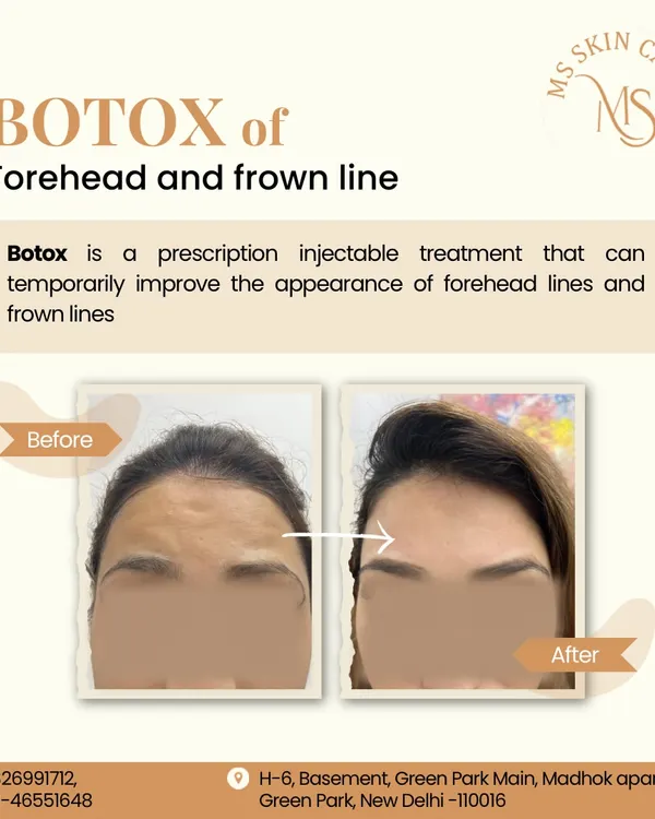 This is a powerful example of how I use Botox to smooth deep-set forehead and frown lines. The goal is always a natural, refreshed appearance, not a "frozen" look. This simple procedure can take years off your appearance and prevent lines from becoming permanently etched into the skin.