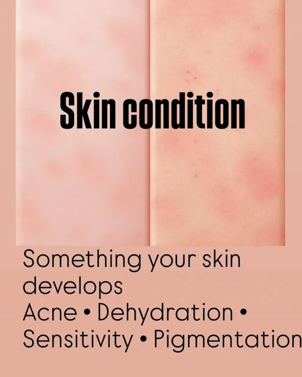 Understanding the difference between your skin type and your skin condition is key. Your type is what you're born with, but your condition (like acne or dehydration) can change.