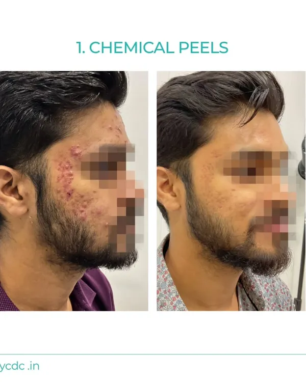 This patient's journey shows a significant reduction in active acne and inflammation after a series of customized chemical peels. The treatment helped clear his skin and improve overall texture.