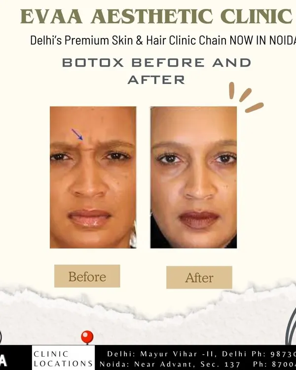 A real client before-and-after of a Botox treatment. The image clearly shows the smoothing of deep frown lines between the eyebrows, resulting in a more relaxed and less tired appearance.