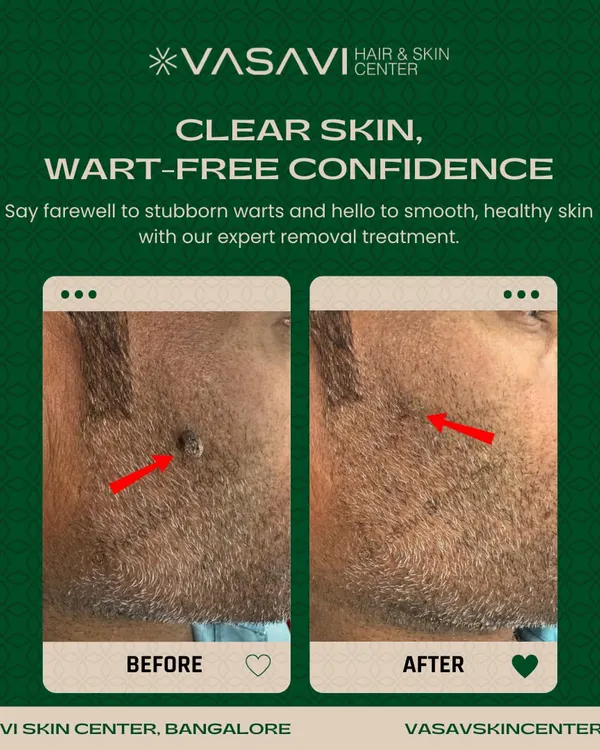 This demonstrates the precise removal of a facial wart from a patient's beard area. Treating facial growths requires careful technique to ensure complete removal and prevent scarring, which is my primary goal for all my patients.