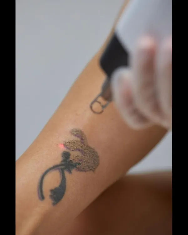 This image captures the "frosting" effect that occurs immediately during a laser tattoo removal session. This is a normal and temporary reaction where the laser energy has successfully targeted and broken up the tattoo ink particles beneath the skin.
